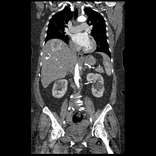 File:Aortic dissection - Stanford type B (Radiopaedia 88281-104910 B 38).jpg