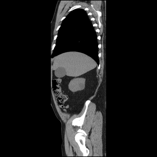 File:Aortic intramural hematoma (type B) (Radiopaedia 79323-92387 G 4).jpg
