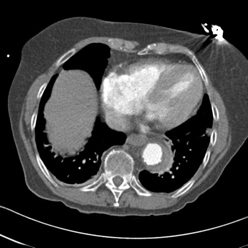 Aortic intramural hematoma from penetrating atherosclerotic ulcer (Radiopaedia 31137-31836 A 59).jpg