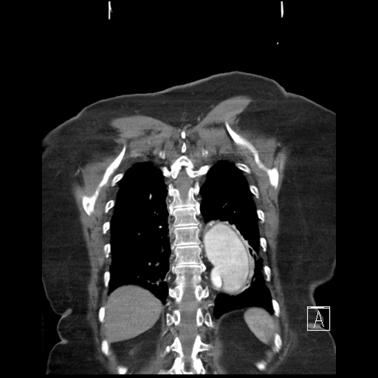 File:Aortic intramural hematoma with dissection and intramural blood pool (Radiopaedia 77373-89491 C 55).jpg