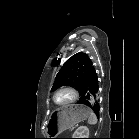 Aortic intramural hematoma with dissection and intramural blood pool (Radiopaedia 77373-89491 D 70).jpg