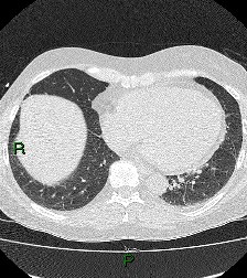 File:Aortic valve endocarditis (Radiopaedia 87209-103485 Axial lung window 71).jpg