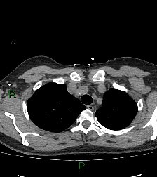Aortic valve endocarditis (Radiopaedia 87209-103485 Axial non-contrast 23).jpg