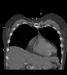 File:Aortic valve endocarditis (Radiopaedia 87209-103485 D 55).jpg