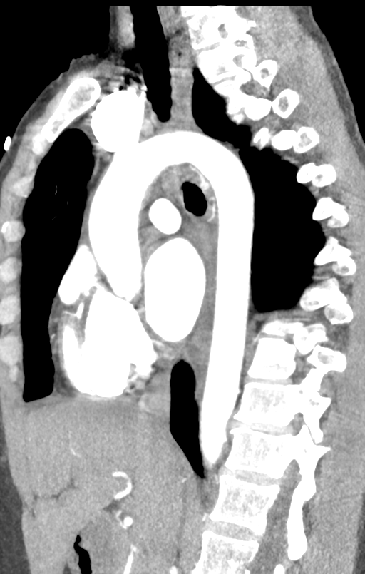Aortic valve non-coronary cusp thrombus (Radiopaedia 55661-62189 C+ arterial phase 30).png