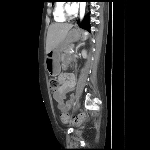 File:Aorto-duodenal fistula (Radiopaedia 25668-25850 C+ arterial phase 13).jpg