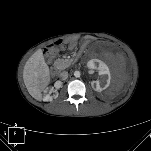 File:Aorto-left renal vein fistula (Radiopaedia 45534-49628 A 23).jpg