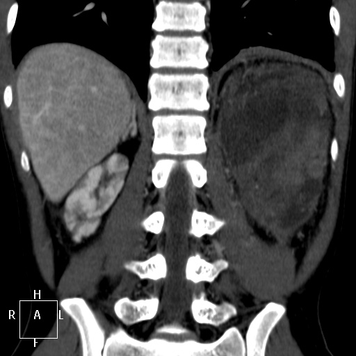 File:Aorto-left renal vein fistula (Radiopaedia 45534-49628 B 56).jpg