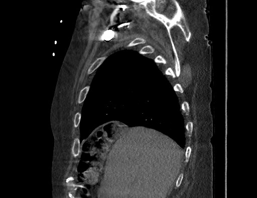 Aortoesophageal fistula with endovascular repair (Radiopaedia 73781-84592 Sagittal C+ CTPA 29).jpg