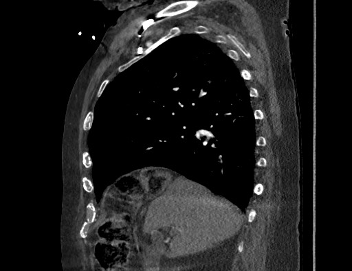 Aortoesophageal fistula with endovascular repair (Radiopaedia 73781-84592 Sagittal C+ CTPA 61).jpg