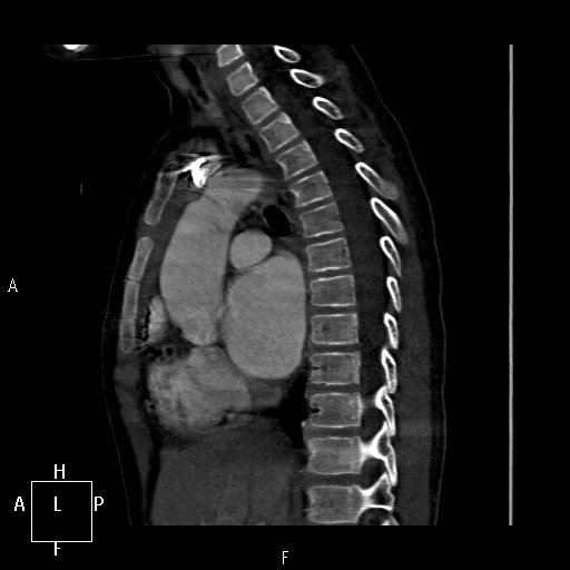 File:Aortopulmonary septal defect (Radiopaedia 41990-45013 Sagittal C+ CTPA 29).jpg