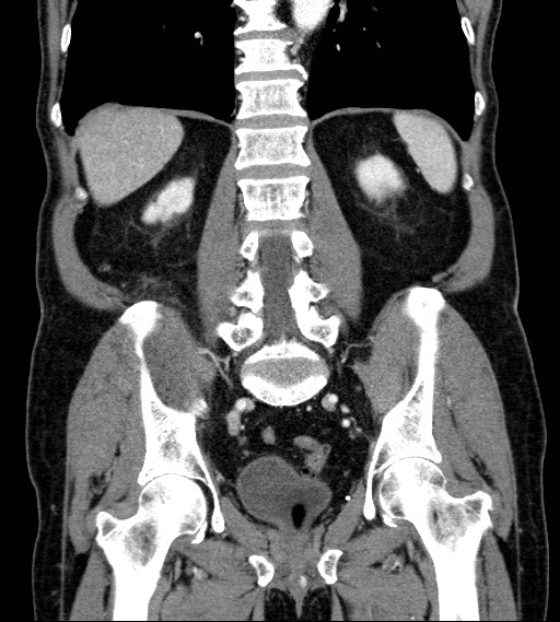 File:Appendiceal adenocarcinoma complicated by retroperitoneal abscess (Radiopaedia 58007-65039 A 60).jpg