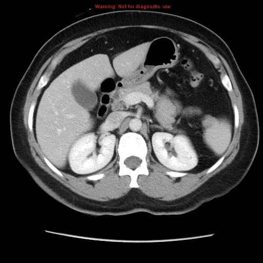 Appendiceal mucinous cystadenoma (Radiopaedia 8263-9111 Axial liver window 29).jpg