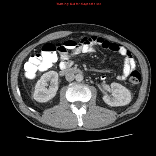 Appendicitis and renal cell carcinoma (Radiopaedia 17063-16760 A 25).jpg