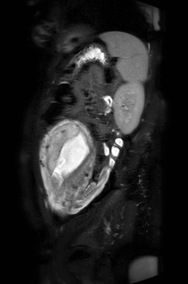 Appendicitis in gravida (MRI) (Radiopaedia 89433-106395 Sagittal T2 SPAIR 16).jpg