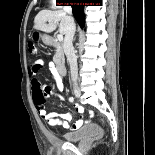 File:Appendicitis mass in inguinal hernia (Radiopaedia 26858-27029 C 24).jpg