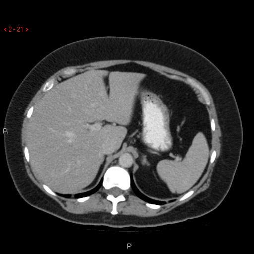 File:Appendicitis with microperforation- promontoric type (Radiopaedia 27268-27442 C 9).jpg