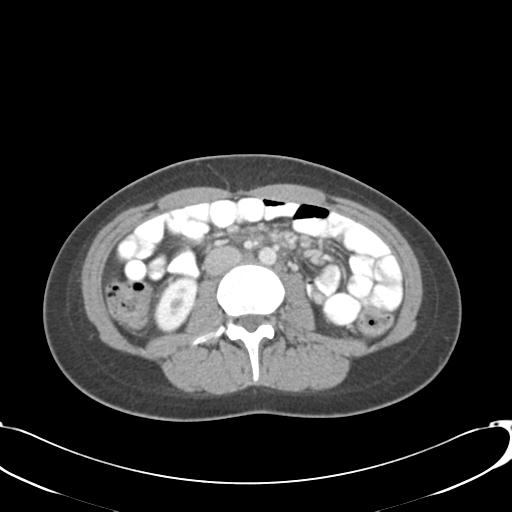 Appendicitis with minimal stranding but appendicolith (Radiopaedia 29035-29397 A 42).jpg