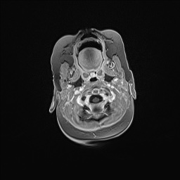 Aqueductal stenosis (Radiopaedia 73974-84802 Axial T1 C+ 33).jpg