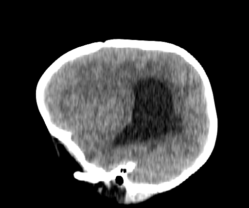 Arachnoid cyst-posterior fossa (Radiopaedia 88661-105370 C 16).jpg