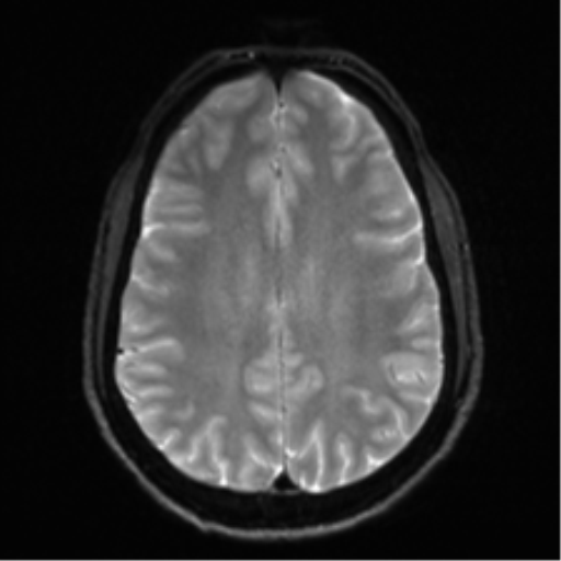 File:Arachnoid cyst - cerebellopontine angle (Radiopaedia 59689-67083 Axial DWI 24).png