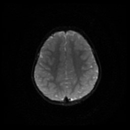 File:Arachnoid cyst - middle cranial fossa (Radiopaedia 86780-102938 Axial DWI 37).jpg