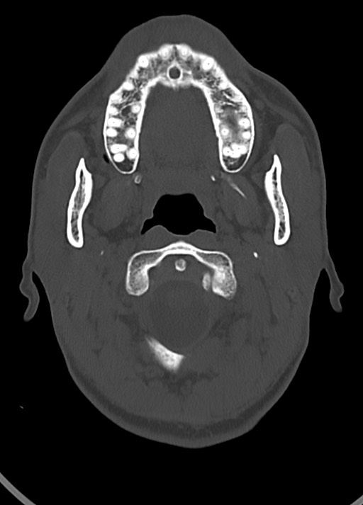 Arrow injury to the head (Radiopaedia 75266-86388 Axial bone window 38).jpg