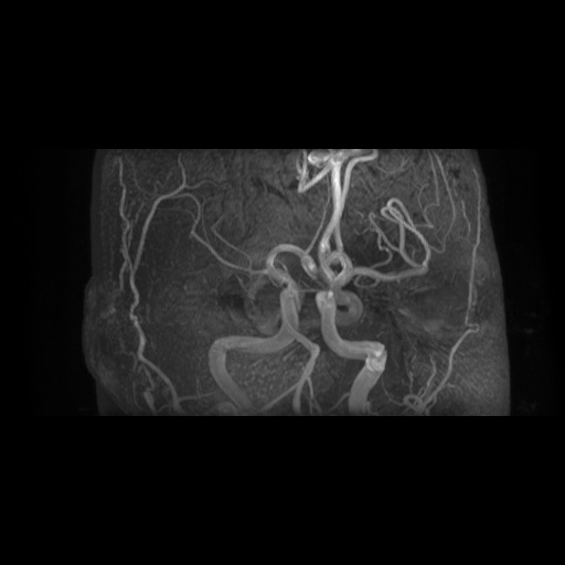 File:Arteriovenous malformation (Radiopaedia 71628-81999 Axial MRA 13).jpg
