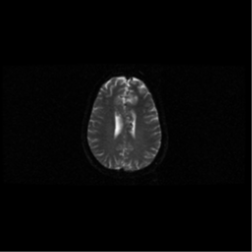 File:Arteriovenous malformation (cerebral) (Radiopaedia 40070-42580 Axial DWI 37).png
