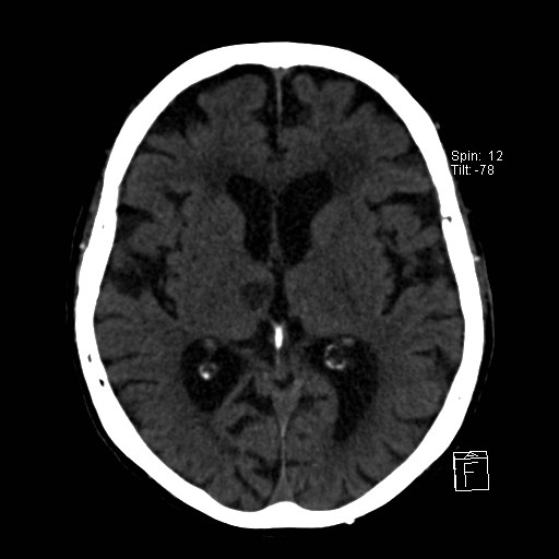 File:Artery of Percheron infarction (Radiopaedia 26307-26439 Axial non-contrast 20).jpg