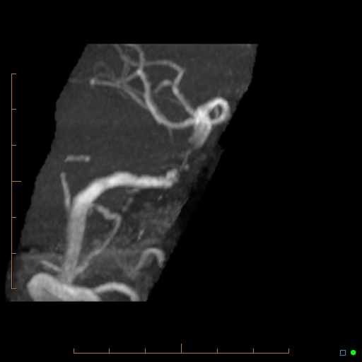 File:Artifactual basilar artery stenosis due to metallic stent (Radiopaedia 31206-31922 3D MIP 10).jpg