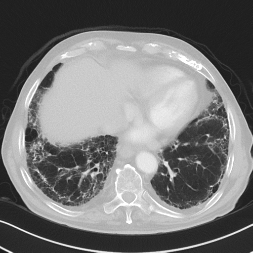 File:Asbestosis (Radiopaedia 56192-62864 Axial lung window 46).png