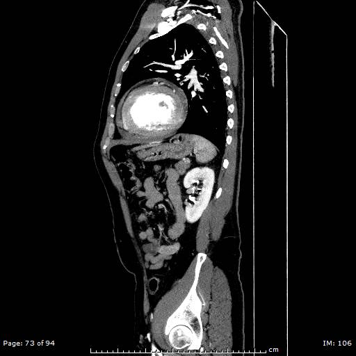 File:Ascending aortic aneurysm (Radiopaedia 50086-55404 C 52).jpg
