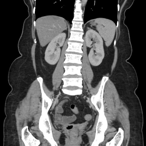 Ascending colon diverticulitis (Radiopaedia 61970-70040 B 42).jpg