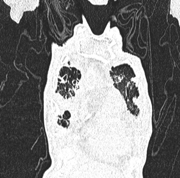 File:Aspergilloma- with Monod sign (Radiopaedia 44737-48532 Coronal lung window 135).jpg