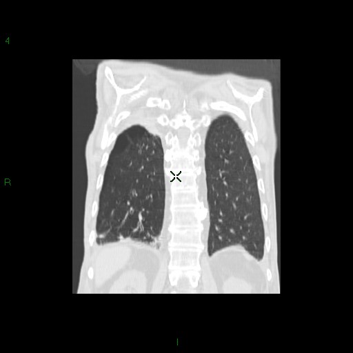 File:Aspergilloma (Radiopaedia 14842-14787 Coronal lung window 29).jpg
