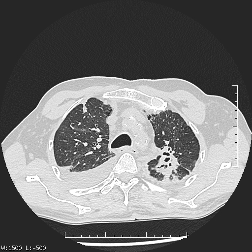 Aspergilloma (Radiopaedia 75184-86270 Axial lung window 13).jpg