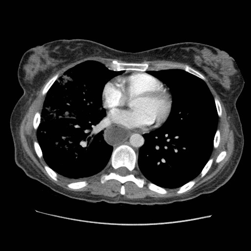 File:Aspiration pneumonia secondary to laparoscopic banding (Radiopaedia 18345-18183 A 31).jpg