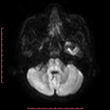 Astroblastoma (Radiopaedia 74287-85162 Axial DWI 18).jpg