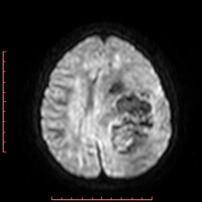 File:Astroblastoma (Radiopaedia 74287-85162 Axial DWI 67).jpg