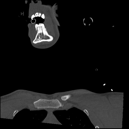 Atlanto-occipital dissociation (Traynelis type 1), C2 teardrop fracture, C6-7 facet joint dislocation (Radiopaedia 87655-104061 Coronal bone window 3).jpg