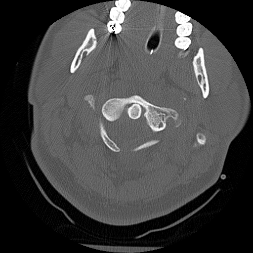 Atlanto-occipital dissociation injury (Radiopaedia 29274-29698 Axial bone window 16).png