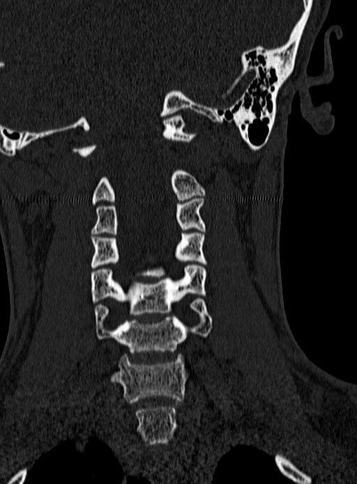 Atlantoaxial subluxation (Radiopaedia 44681-48450 Coronal bone window 73).jpg
