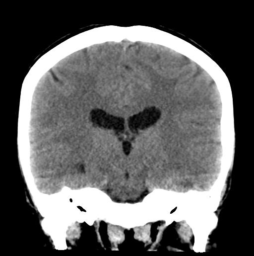 File:Atretic encephalocoele with inferior vermis hypoplasia (Radiopaedia 30443-31107 Coronal non-contrast 22).jpg