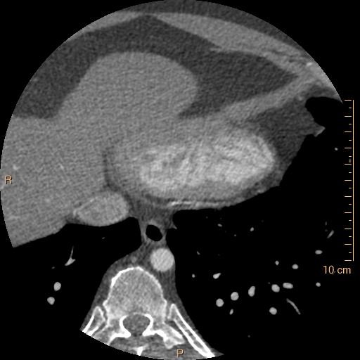 Atrial septal defect (upper sinus venosus type) with partial anomalous pulmonary venous return into superior vena cava (Radiopaedia 73228-83961 A 241).jpg