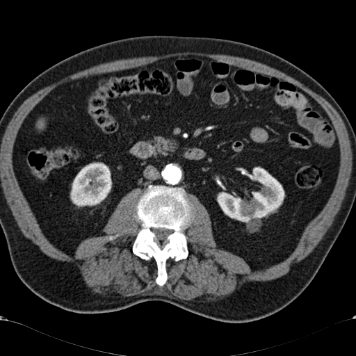 Atypical hepatocellular carcinoma (Radiopaedia 41744-44698 A 55).jpg