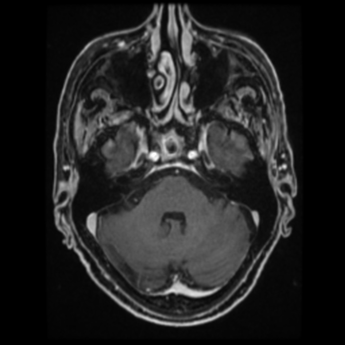 Atypical meningioma (Radiopaedia 45535-49629 Axial T1 C+ 25).jpg