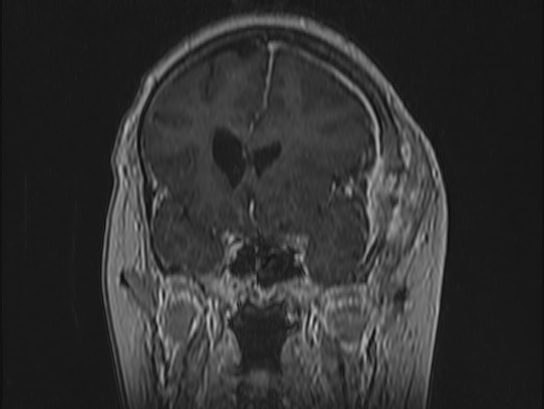 Atypical meningioma (Radiopaedia 62985-71406 Coronal T1 C+ 38).jpg