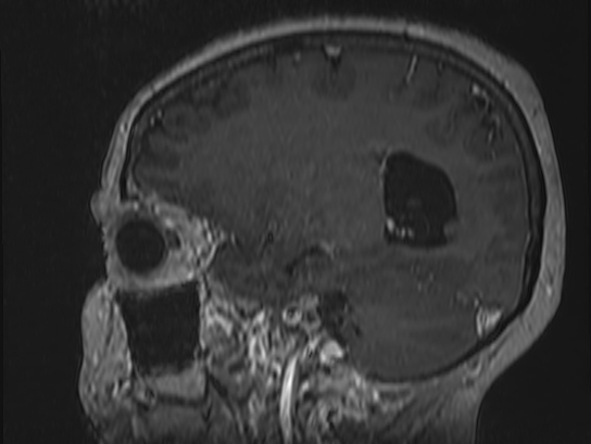 Atypical meningioma (Radiopaedia 62985-71406 Sagittal T1 C+ 26).jpg