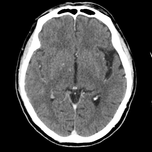 Atypical meningioma (WHO grade II) with osseous invasion (Radiopaedia 53654-59715 Axial C+ delayed 26).png